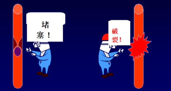 警惕“中风”突袭！脑卒中全面科普(图2)